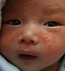 根治婴儿面部湿疹 新生儿面部湿疹 婴儿面部湿疹