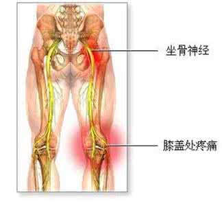 坐骨神经痛偏方秘方 坐骨神经炎2方