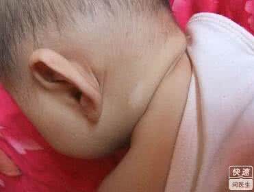 儿童遗传病 白癜风遗传吗？儿童白癜风如何治疗？