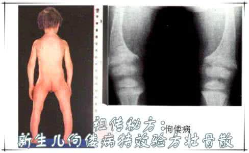 祖传秘方偏方验方大全 祖传秘方:新生儿佝偻病特效验方壮骨散
