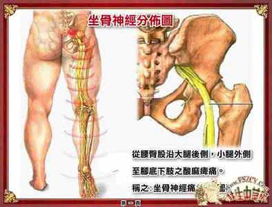 坐骨神经痛贴膏药部位 坐骨神经痛，你痛的是哪个部位？不同部位的坐骨神经痛应区别应对