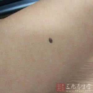 恶性肿瘤 这里有黑点竟是恶性肿瘤 - 今日头条(TouTiao.com)