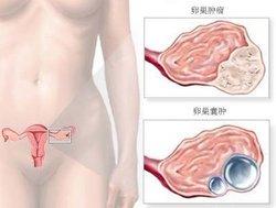 附件囊肿鉴别诊断 右侧附件囊肿 如何诊断右侧附件囊肿