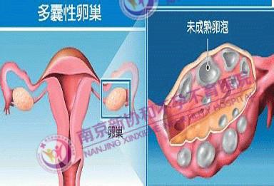 卵巢不排卵是什么原因 卵巢不排卵的原因 卵巢不排卵是什么原因