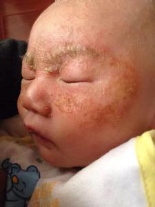 满身起湿疹是否传染 为什么满身都是湿疹 禧月阁科普 | 宝妈错在哪,竟导致宝宝湿疹满身?