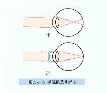 近视眼矫正原理 近视眼矫正原理 近视矫正 近视眼矫正的原理是什么