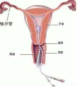 输卵管不通怎么生育 输卵管不通怎么生育？