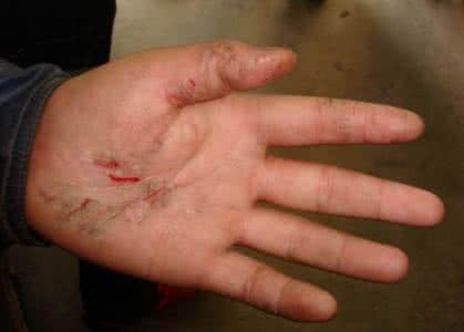 皲裂性湿疹怎么治疗 皲裂性湿疹 皲裂性湿疹怎么治疗