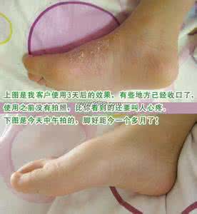 长脚气的原因 长脚气的原因 脚气对人体有哪些危害