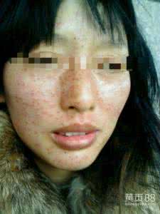 祛斑产品3强 祛斑来试试他们