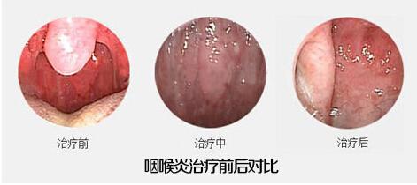自疗荨麻疹的方法 自疗咽喉炎八方法