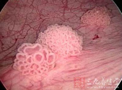 膀胱肿瘤能吃西瓜吗 桐庐男子继发膀胱肿瘤 有西瓜般大