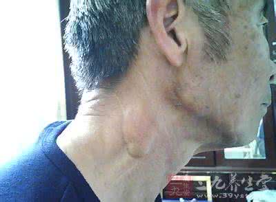 身体出现肿块 身体 身体出现这些肿块要警醒