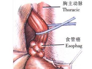 食道癌肿瘤标志物 食道瘤能活多久 如何治疗食道癌