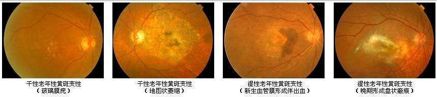 黄斑变性治疗方法 黄斑变性 黄斑变性的治疗方法有哪些