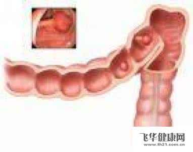 直肠癌的早期症状 直肠癌的早期症状 直肠癌的早期表现是什么