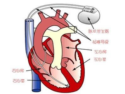 糖尿病肾病 糖尿病友如何保护“心脑肾”？重视高血压！《揭秘糖尿病防治误区》连载第三章30