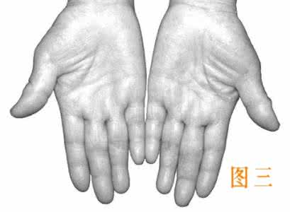 癌症看掌纹 《癌症看掌纹》