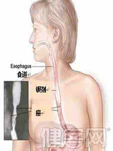 食道癌放疗的效果 食道癌放疗 食道癌的治疗效果