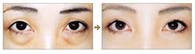 眼袋手术后的护理 眼袋手术后护理 去眼袋手术后的护理方法