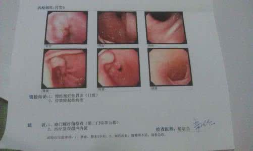 胃镜检查活检 胃镜检查活检 胃镜活检是检查癌变吗?