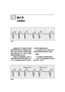 心电图知识快速入门 谷云飞：起搏心电图快速入门
