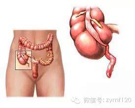 中医秘方绝技大公开 秘阑尾炎特效秘方,大公开,赠方救人