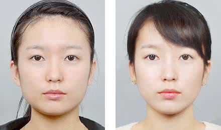 怎么变锥子脸 锥子脸 怎么让脸变瘦