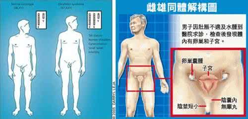 特纳氏综合症 特纳氏综合症 它有哪些临床表现