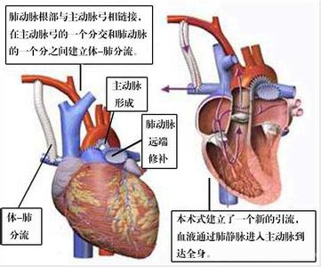 三尖瓣闭锁 三尖瓣闭锁的治疗 三尖瓣闭锁的西医治疗