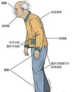 帕金森最佳治疗方法 帕金森症状 帕金森最佳治疗方法