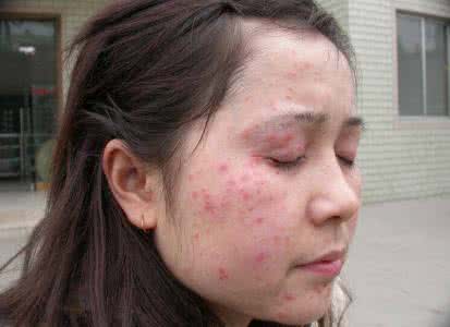 紫外线过敏该怎么办 紫外线过敏该怎么办 宝宝过敏了该怎么办呢