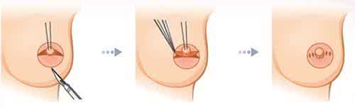 乳头内陷矫正术价目表 乳头内陷 为什么会引起这种疾病