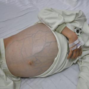 肝癌腹水 肝癌恶性腹水局部治疗及疗效