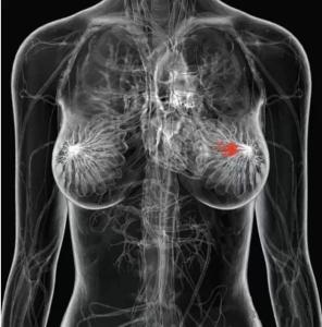 乳腺增生和乳腺癌 根治乳腺增生、初中晚期乳腺癌特效方
