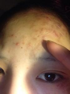 头发里长粉刺 头发里长粉刺 头发里长粉刺什么原因？