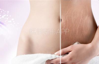激光去妊娠纹亲身经历 激光去妊娠纹亲身经历 治疗妊娠纹 准妈妈亲身体验对付妊娠纹好方法