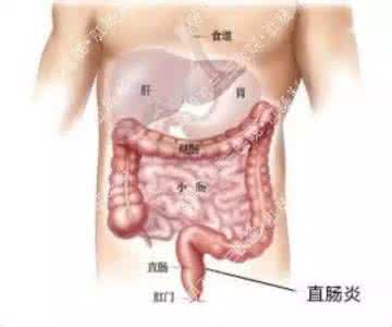 溃疡性直肠炎病因 病因复杂 注意直肠炎症状