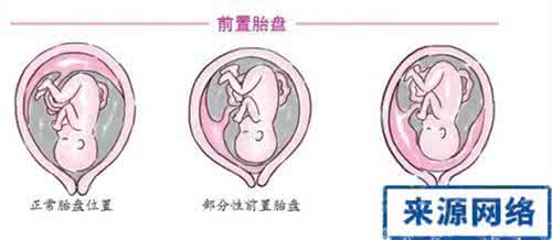 胎盘附着于子宫前壁 胎盘附着面积小怎么办？