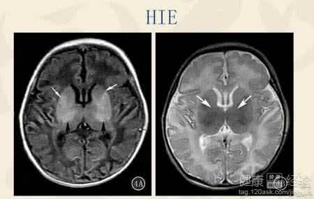 新生儿胆红素脑病 新生儿胆红素脑病 引起它的原因是什么