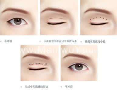 双眼皮手术有什么危害 什么是韩式双眼皮手术