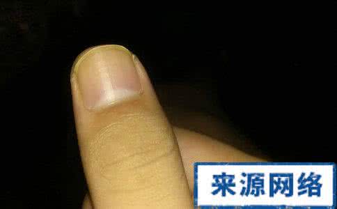 醋泡大蒜治疗灰指甲 灰指甲醋大蒜 治疗灰指甲的偏方