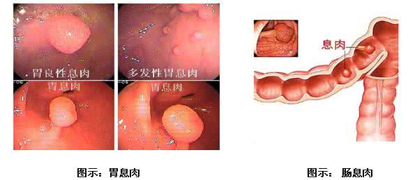 胃息肉是癌症的早期吗 息肉是癌的“近亲”