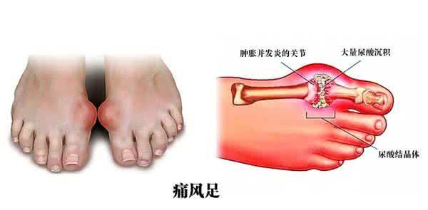 痛风快速止痛的绝招 痛风快速止痛的绝招 多种胃痛一招快速止痛