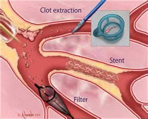 血栓抽吸导管 急性心梗介入血栓抽吸 纯天然的“血管清洁工”，常吃防心梗、化血栓，记得做给家人吃~