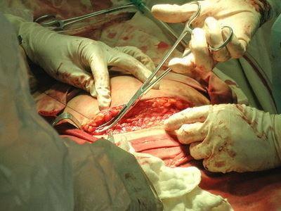 剖腹产对母体的危害 剖腹产有哪些危害