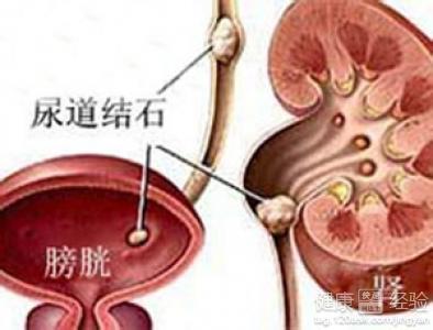 尿道结石应该怎么治疗 尿道结石是什么 尿道结石该怎么治疗