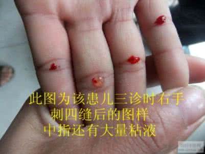 久病难症（疳积）必效方
