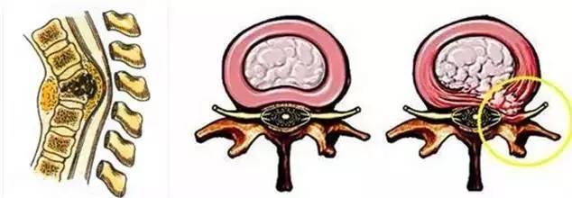 腰椎结核鉴别诊断 鉴别诊断的教训：腰骶椎结核 vs 腰椎间盘突出症