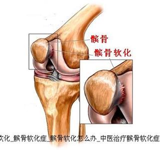 髌骨软化症症状 髌骨软化症 髌骨软化症有什么症状